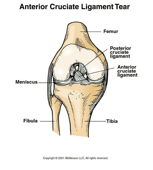Anterior Cruciate Ligament (ACL) Tear:  Illustration