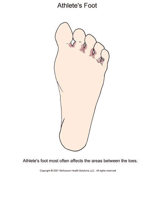 Athlete's Foot:  Illustration