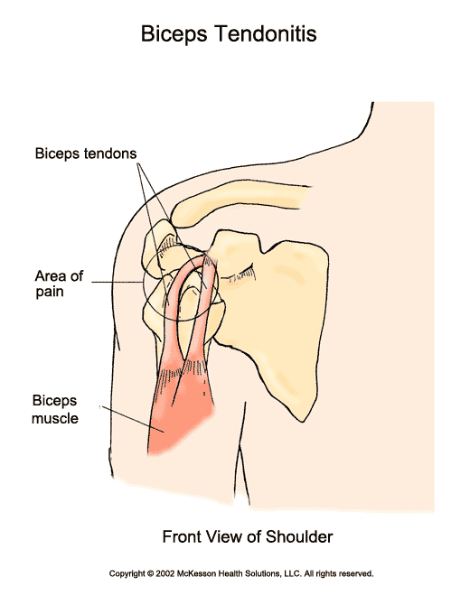 Biceps Tendonitis:  Illustration