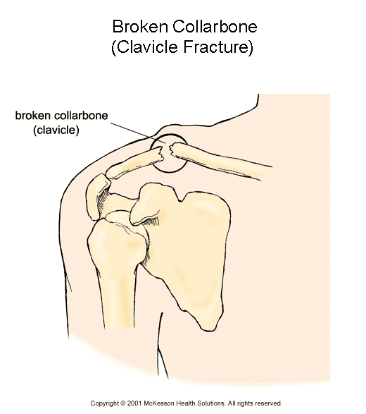 Broken Collarbone (Fractured Clavicle):  Illustration