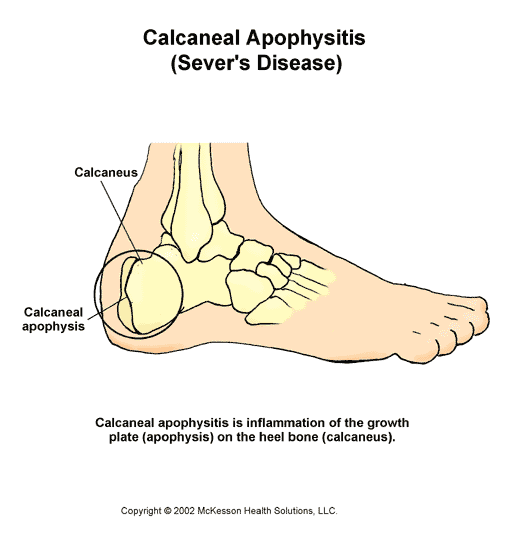 Calcaneal Apophysitis (Sever's Disease):  Illustration
