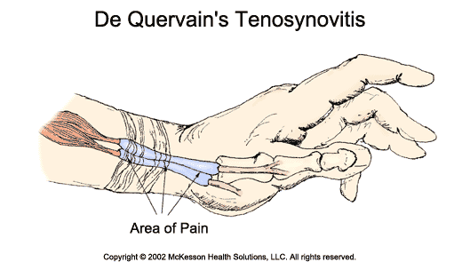 De Quervain's Tenosynovitis:  Illustration