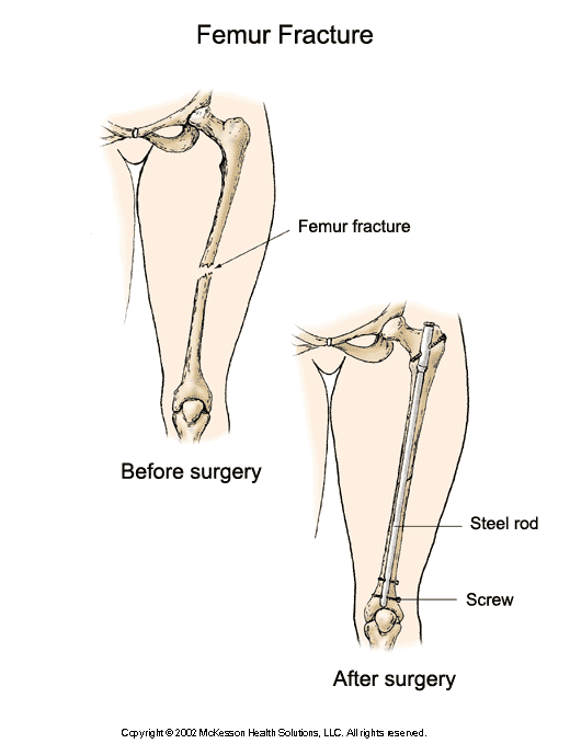 Femur Fracture and Repair:  Illustration