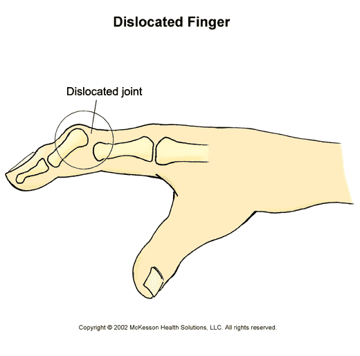 Finger Dislocation:  Illustration