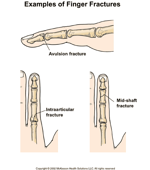 Finger Fractures:  Illustration