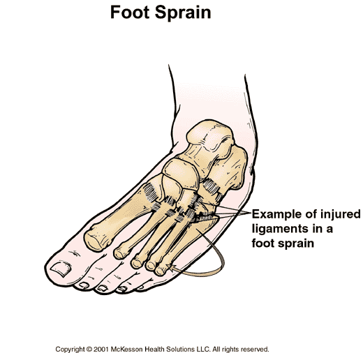 Foot Sprain: Illustration