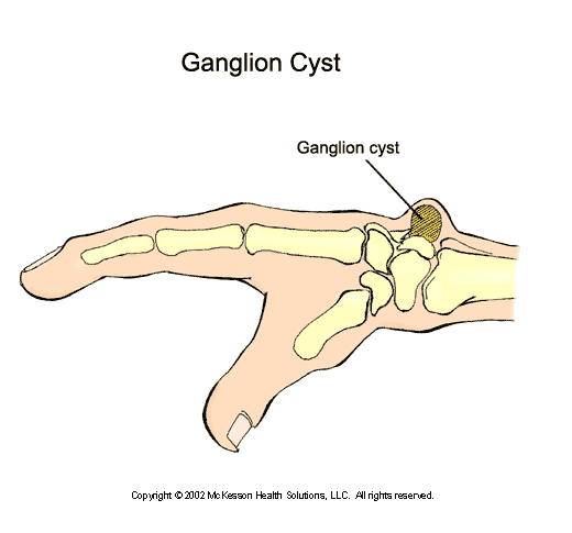 Ganglion Cyst:  Illustration