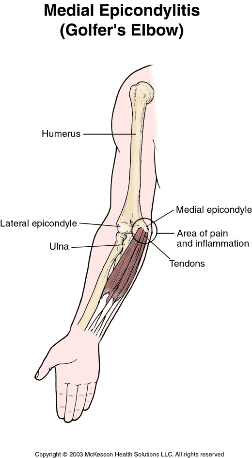 Medial Epicondylitis (Golfer's Elbow):  Illustration