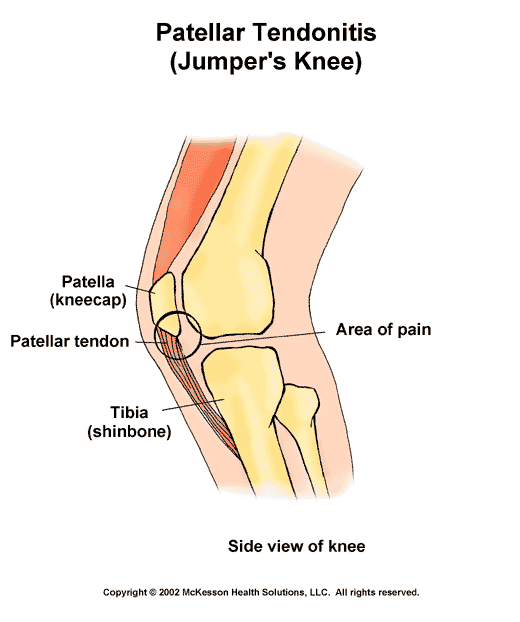 Patellar Tendonitis (Jumper's Knee): Illustration