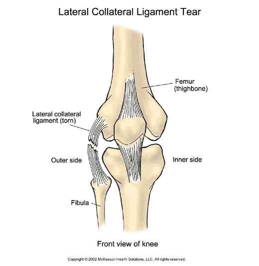 Lateral Collateral Ligament Tear: Illustration