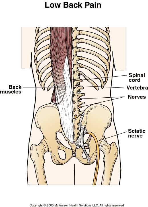 Strained Lower Back Muscles:  Illustration