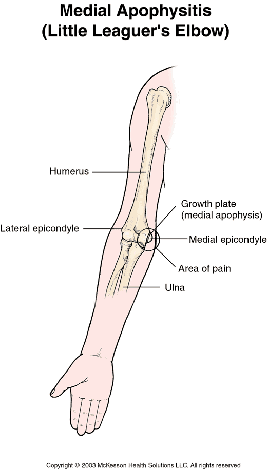 Medial Apophysitis (Little Leaguer's Elbow):  Illustration