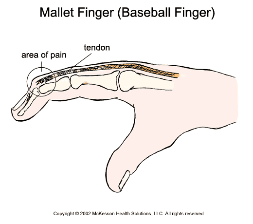 Mallet Finger (Baseball Finger):  Illustration