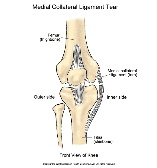 Sports Medicine Advisor 2003.1: Medial Collateral Ligament Tear:  Illustration