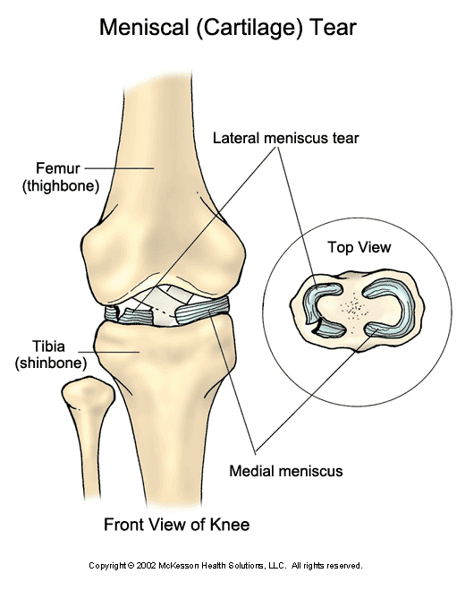 Meniscal (Cartilage) Tear: Illustration