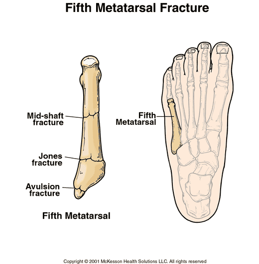 Fifth Metatarsal Fracture:  Illustration