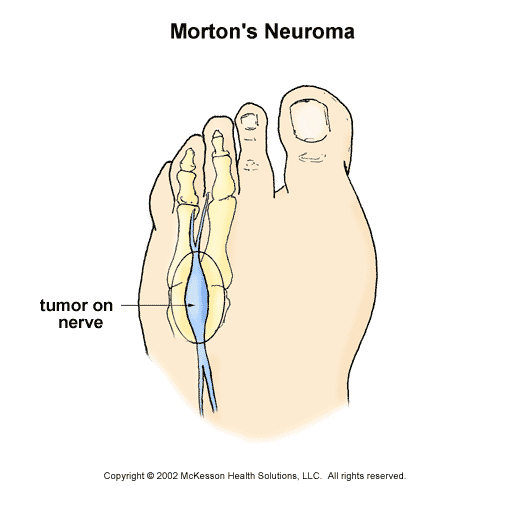 Morton's Neuroma: Illustration