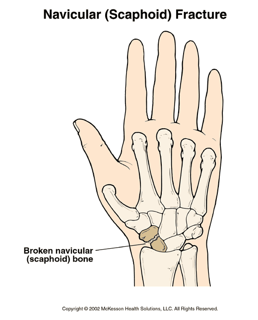 Navicular (Scaphoid) Fracture: Illustration