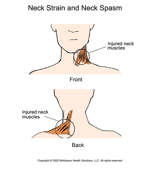 Neck Strain and Neck Spasm: Illustration