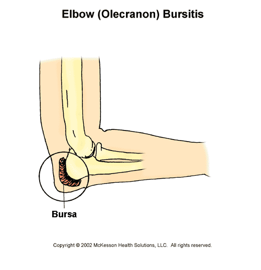 Elbow (Olecranon) Bursitis:  Illustration