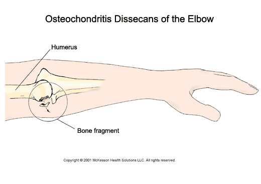 Osteochondritis Dissecans (Bone Chips) of the Elbow: Illustration