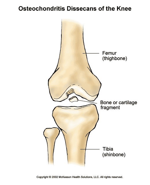 Osteochondritis Dissecans (Bone Chips) of the Knee: Illustration