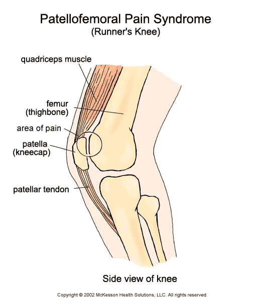 Patellofemoral Pain Syndrome (Runner's Knee):  Illustration