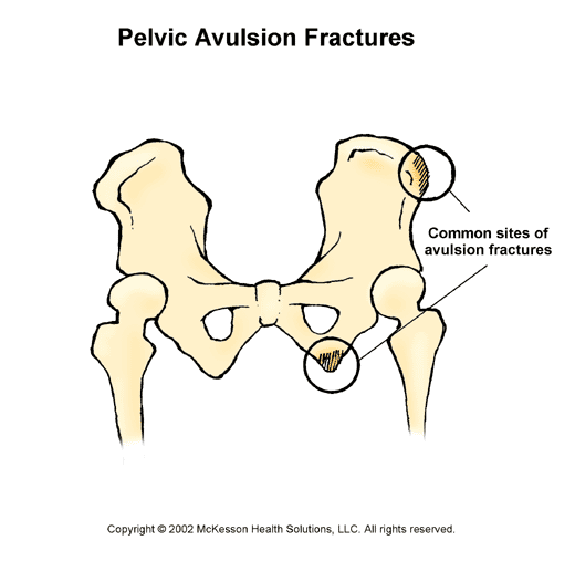Pelvic Avulsion Fractures:  Illustration