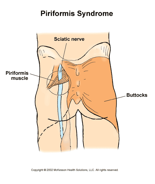 Piriformis Syndrome:  Illustration