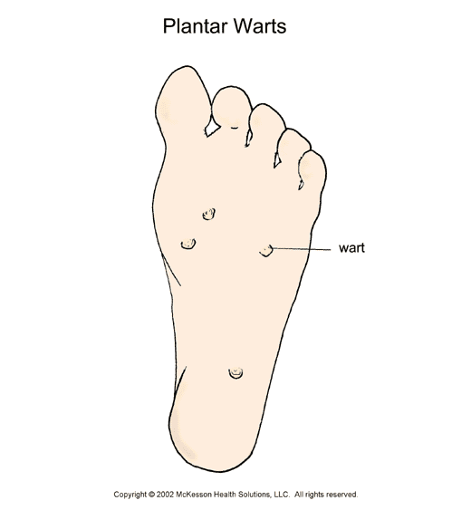 Plantar Warts:  Illustration