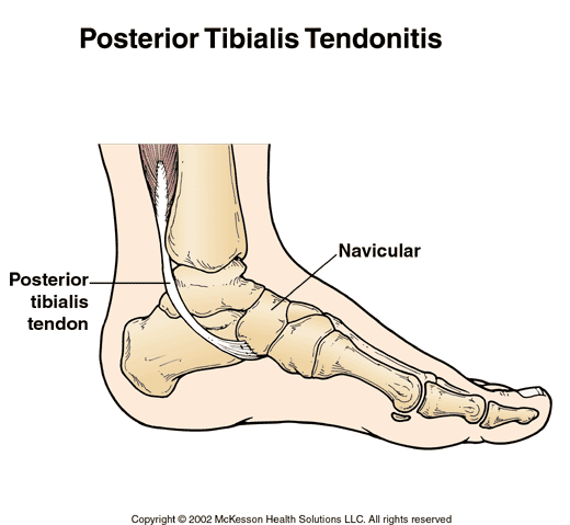 Posterior Tibial Tendonitis:  Illustration
