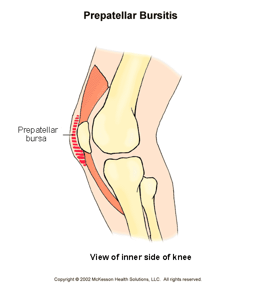 Prepatellar (Knee) Bursitis:  Illustration