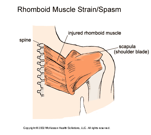 Rhomboid Muscle Strain or Spasm:  Illustration