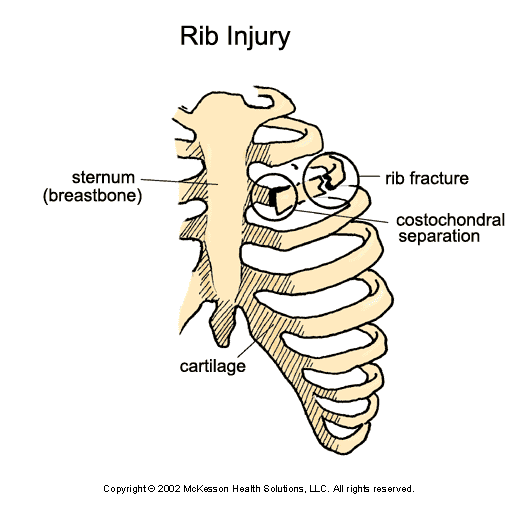 Rib Injury: Illustration