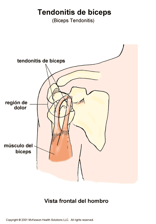 Tendonitis de bceps: ilustracin