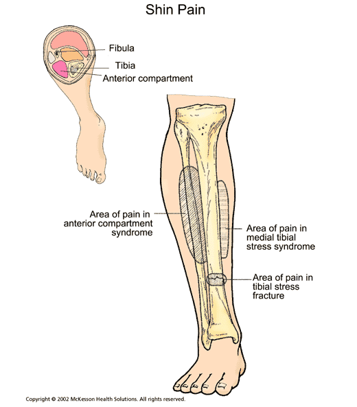 Shin Pain (Shin Splints):  Illustration