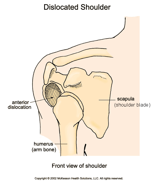 Dislocated Shoulder:  Illustration