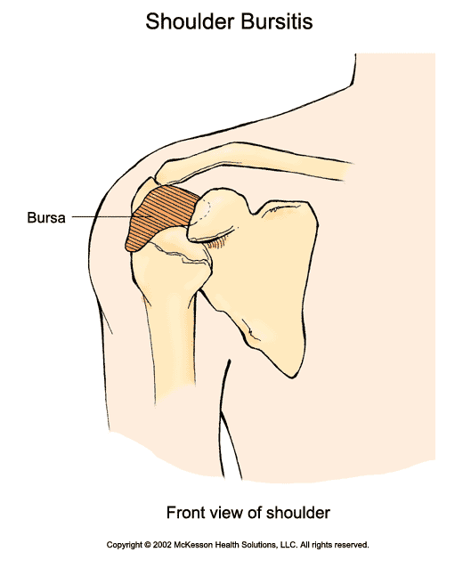 Shoulder Bursitis: Illustration