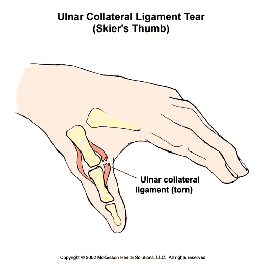 Ulnar Collateral Ligament Sprain (Skier's Thumb): Illustration