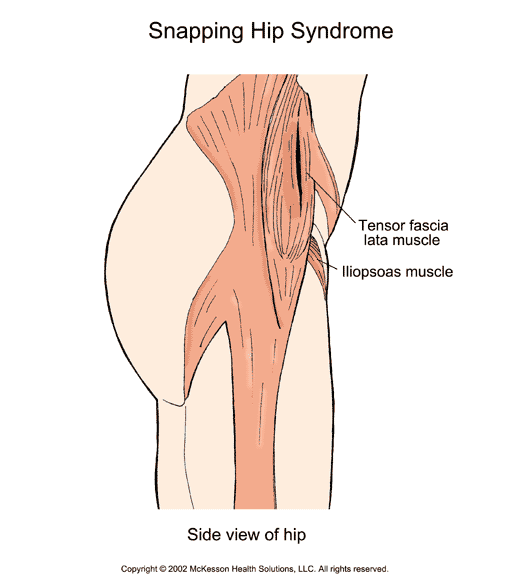 Snapping Hip Syndrome:  Illustration