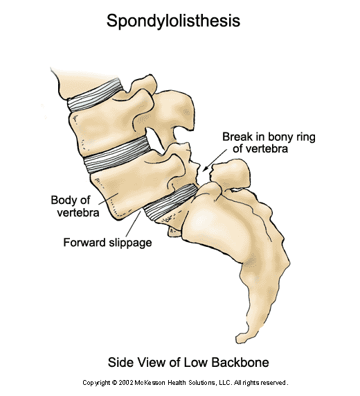 Spondylolisthesis Exercises That Relieve and Prevent Pain