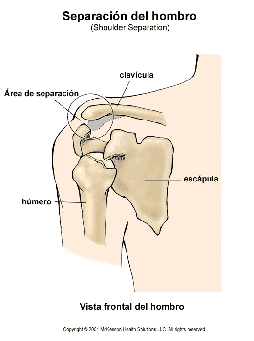 Separacin del hombro: ilustracin