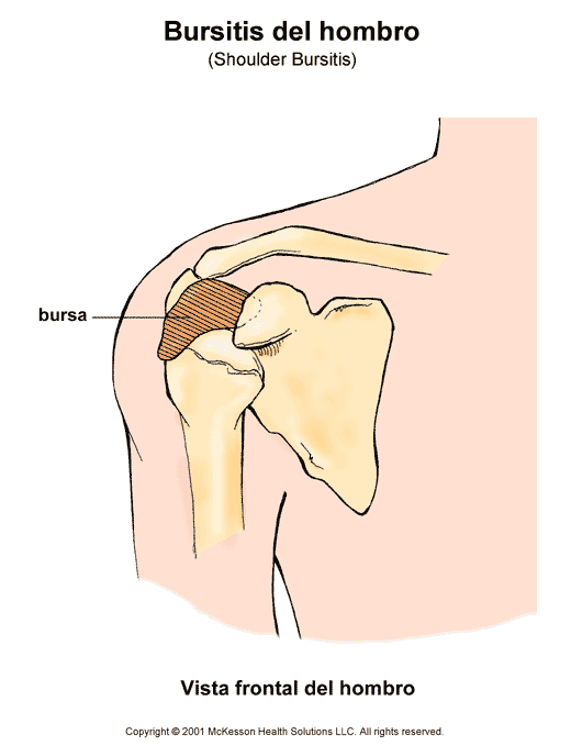 Bursitis del hombro: ilustracin
