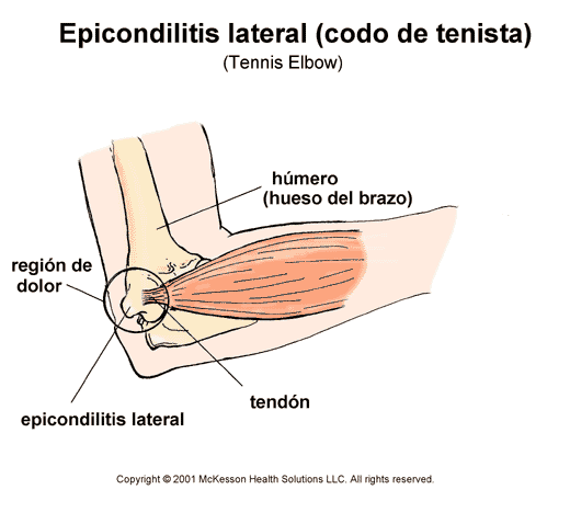 Epicondilitis lateral: ilustracin