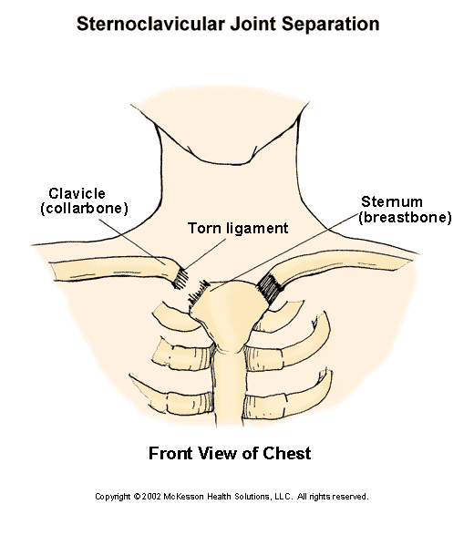Sternoclavicular Joint Separation:  Illustration