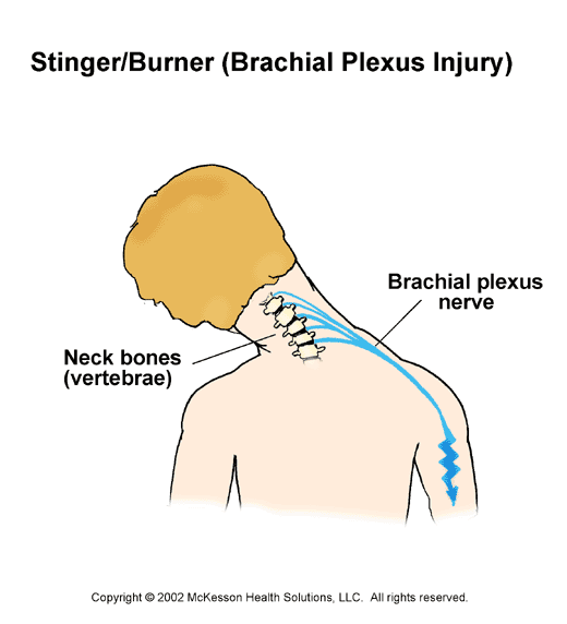 Brachial Plexus Injury (Stinger/Burner):  Illustration