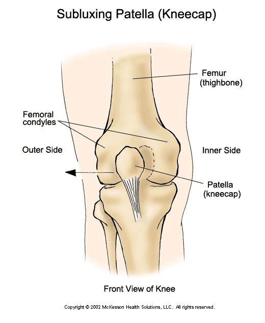 Patellar (Kneecap) Subluxation:  Illustration