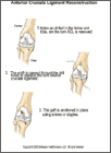 Thumbnail image of: Anterior Cruciate Ligament (ACL) Reconstruction:  Illustration