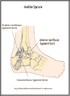 Thumbnail image of: Ankle Sprain:  Illustration