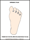 Thumbnail image of: Athlete's Foot:  Illustration